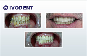 Nepravilan položaj zuba i prebojeni zubi