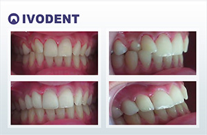 Nepravilan položaj zuba i prebojeni zubi